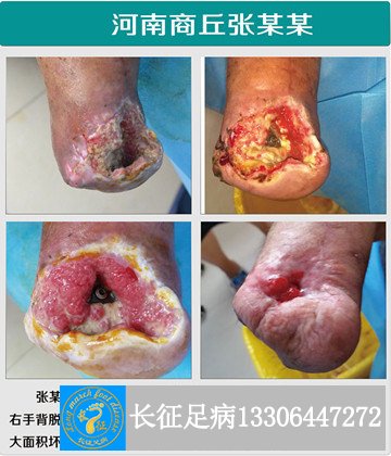 1521016834331695.jpg 术后创面不愈副本.jpg