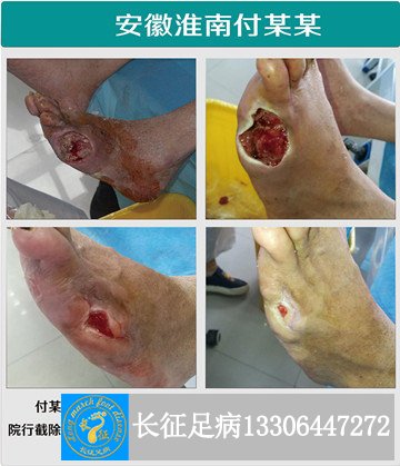 1521101809362193.jpg 小脚趾截肢_副本.jpg
