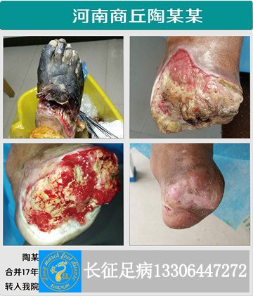 1523331622594937.jpg 5级干性坏疽_副本.jpg
