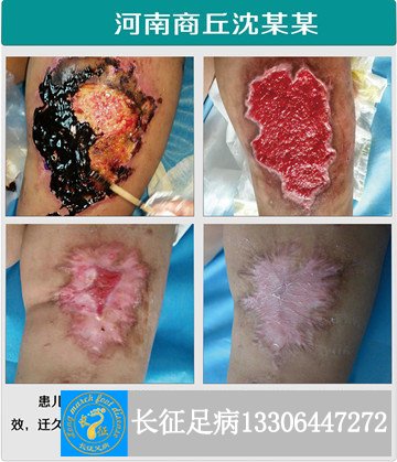 自治不愈合_副本.jpg