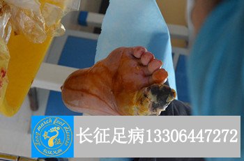 烂脚.jpg